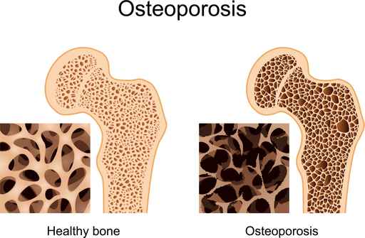 Best Tips for Osteoporosis Prevention and Management